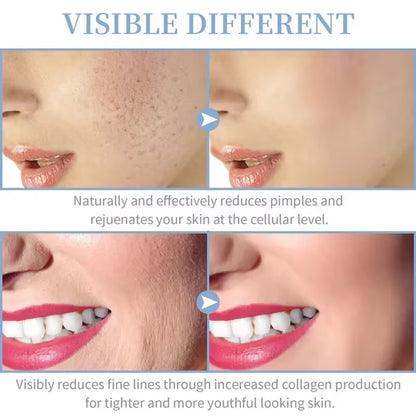 4-in-1 Portable High Frequency Facial Therapy Wand for Acne Treatment and Skin Beauty Care